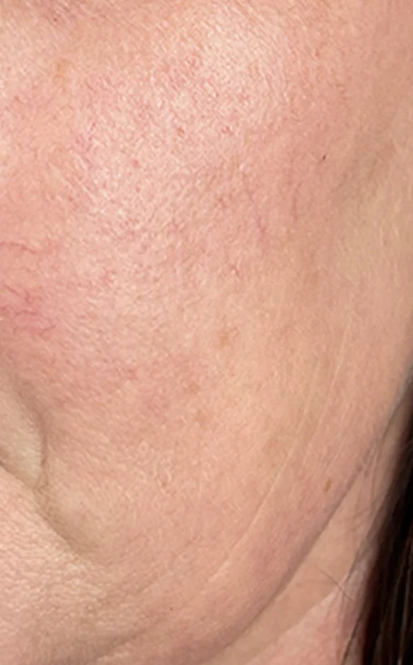 Intense Pulsed Light (IPL) after treatment