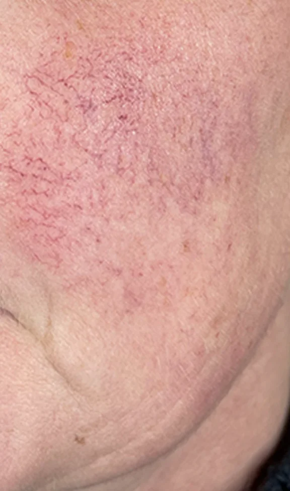 Intense Pulsed Light (IPL) before treatment