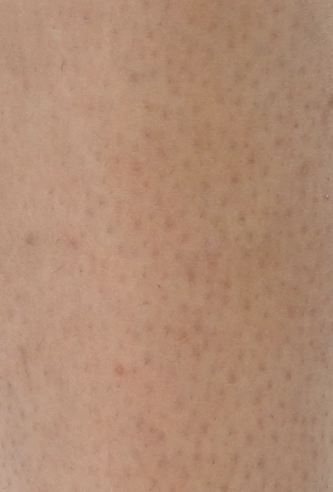 Laser Hair Removal after treatment