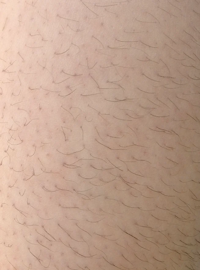 Laser Hair Removal before treatment