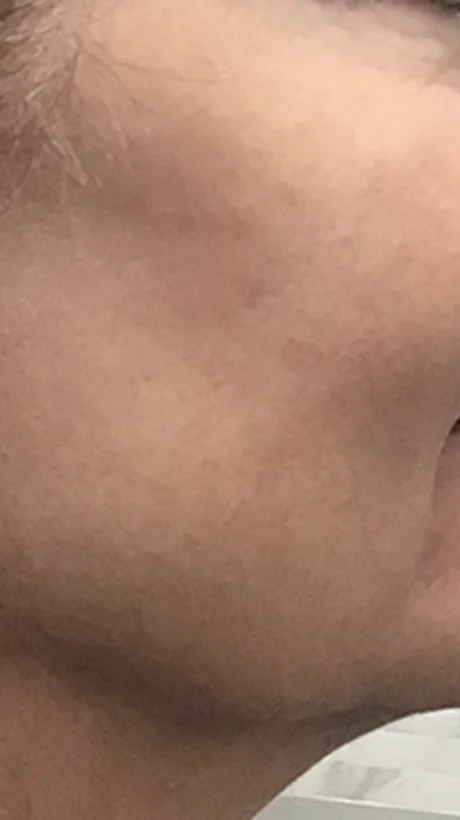 RF MicroNeedling after treatment