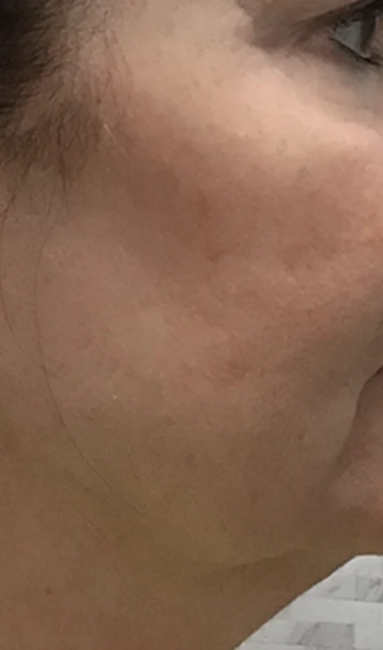 RF MicroNeedling before treatment