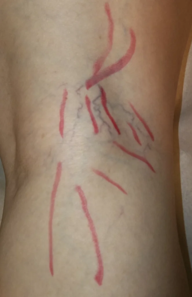 Vein Therapy before treatment